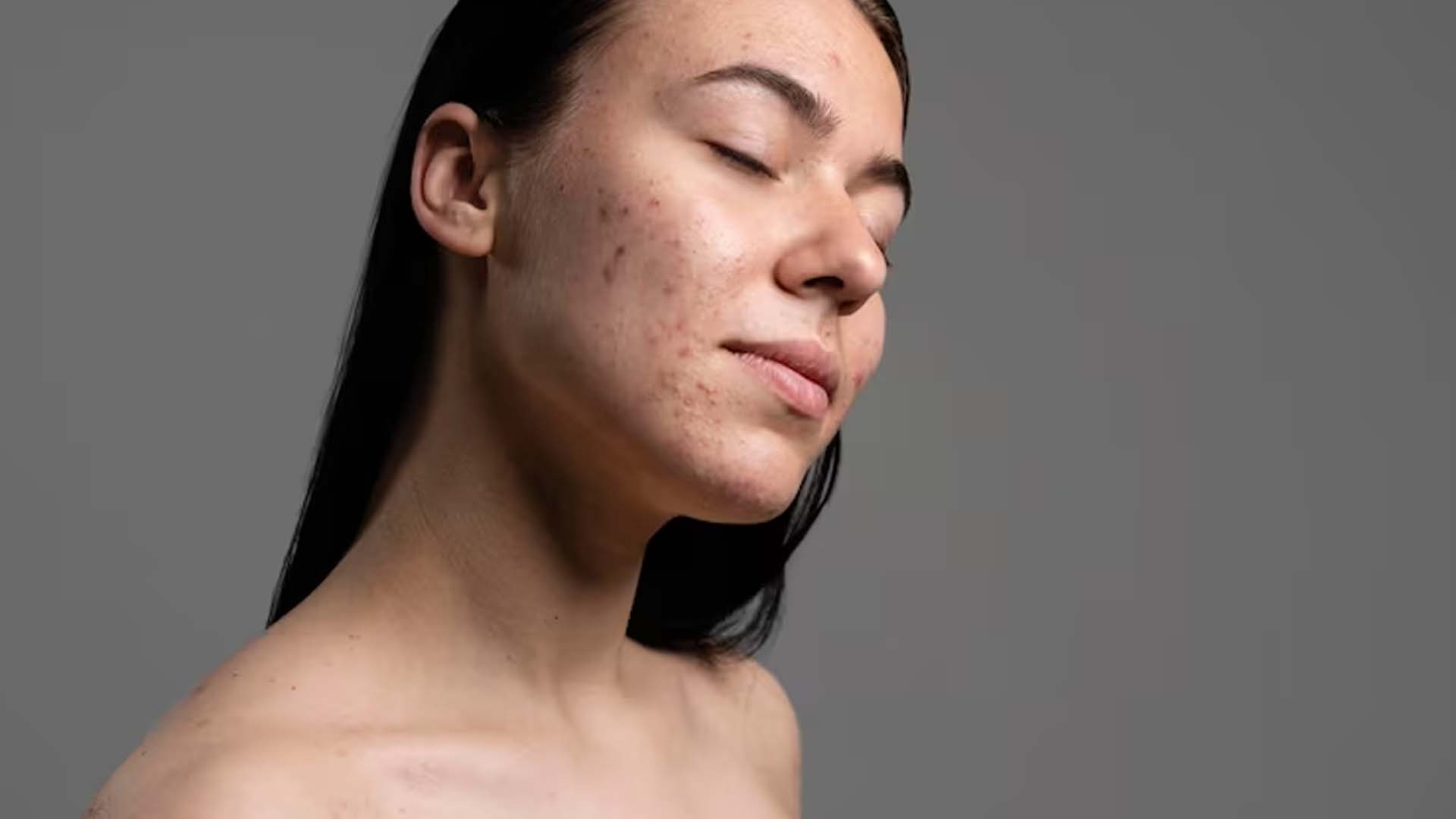 Women with Acne