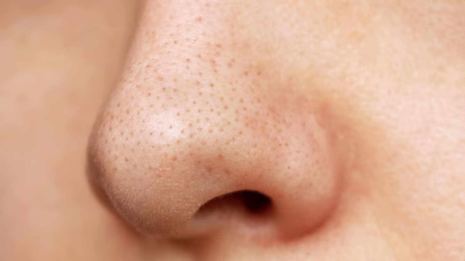 Blackheads on Nose