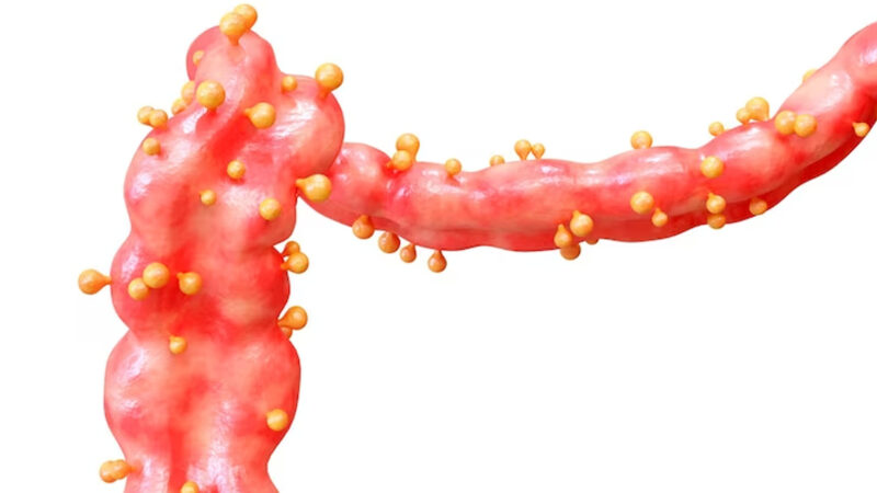 What are the Symptoms of Bleeding Ulcer? – NutritionFact.in