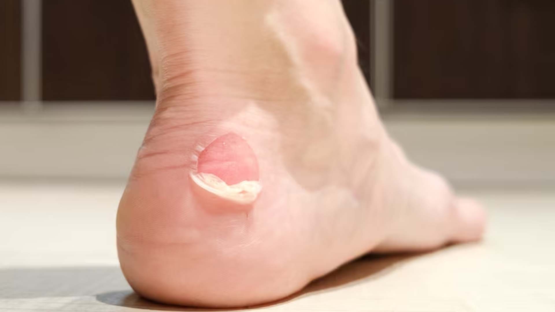 Blisters on foot