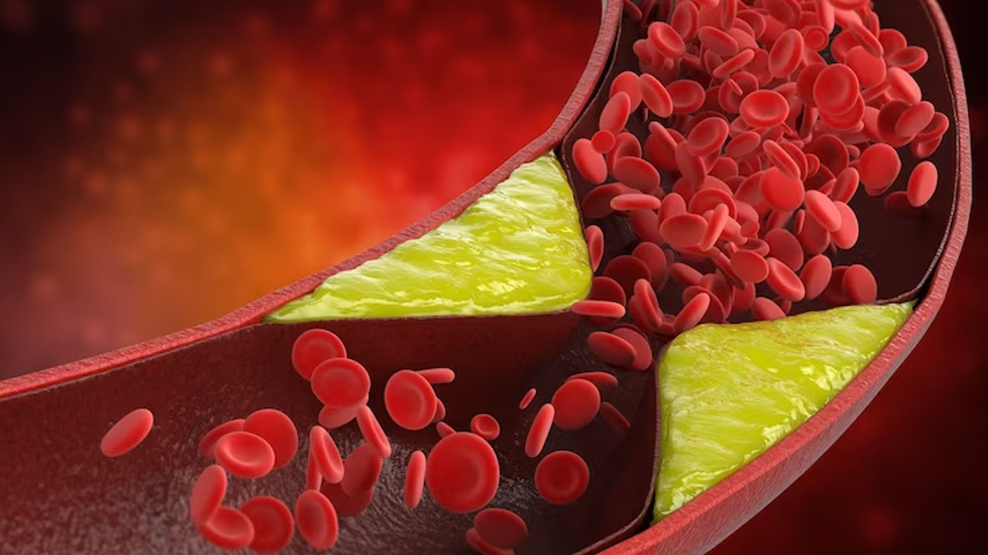 What are the Symptoms of a Blocked Artery?