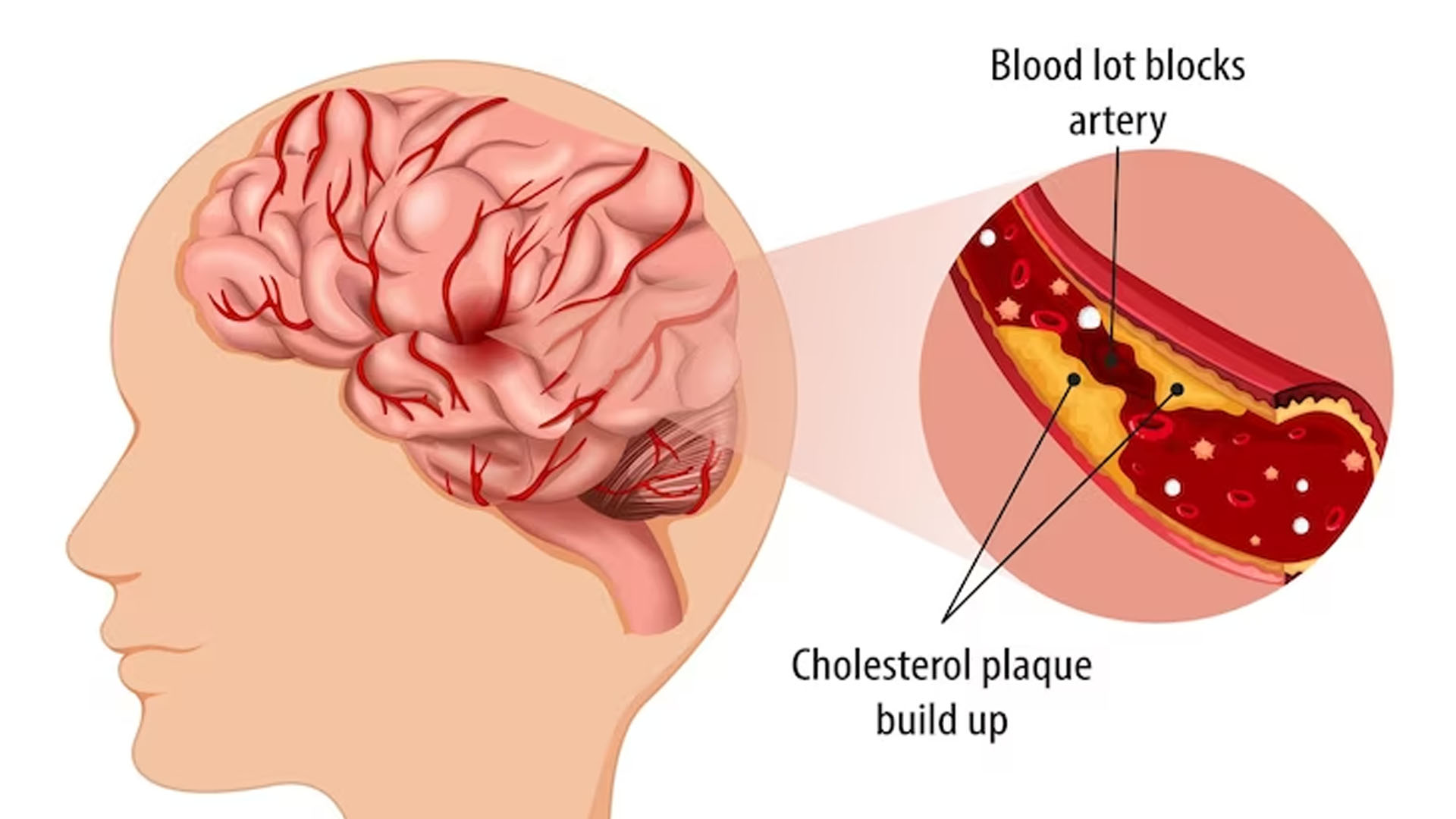 What are the Symptoms of Blood Clot in Brain?