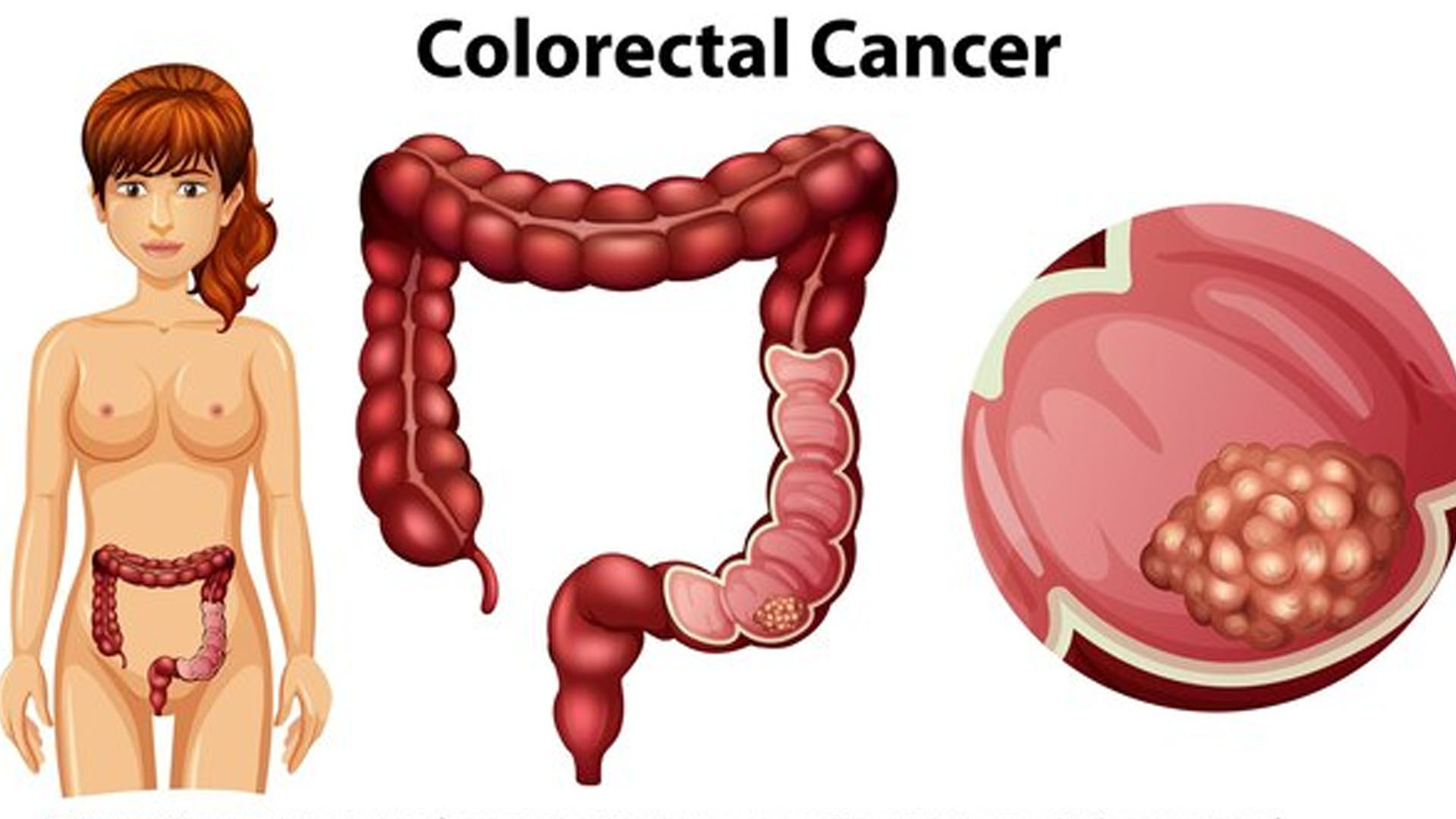 Is Rectal Itching a Symptom of Colon Cancer?