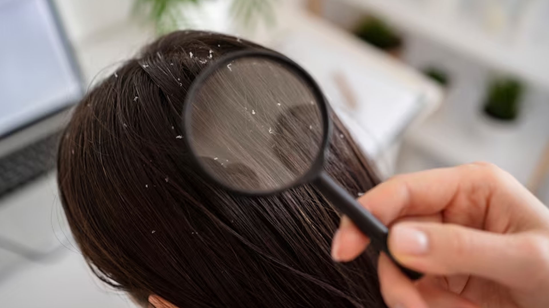 What are the Symptoms of Dandruff?