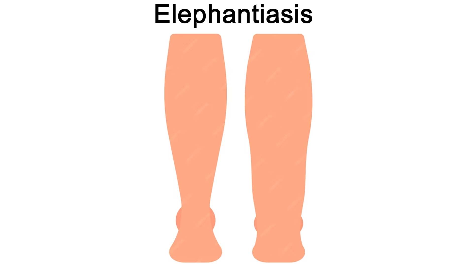 Elephantiasis leg