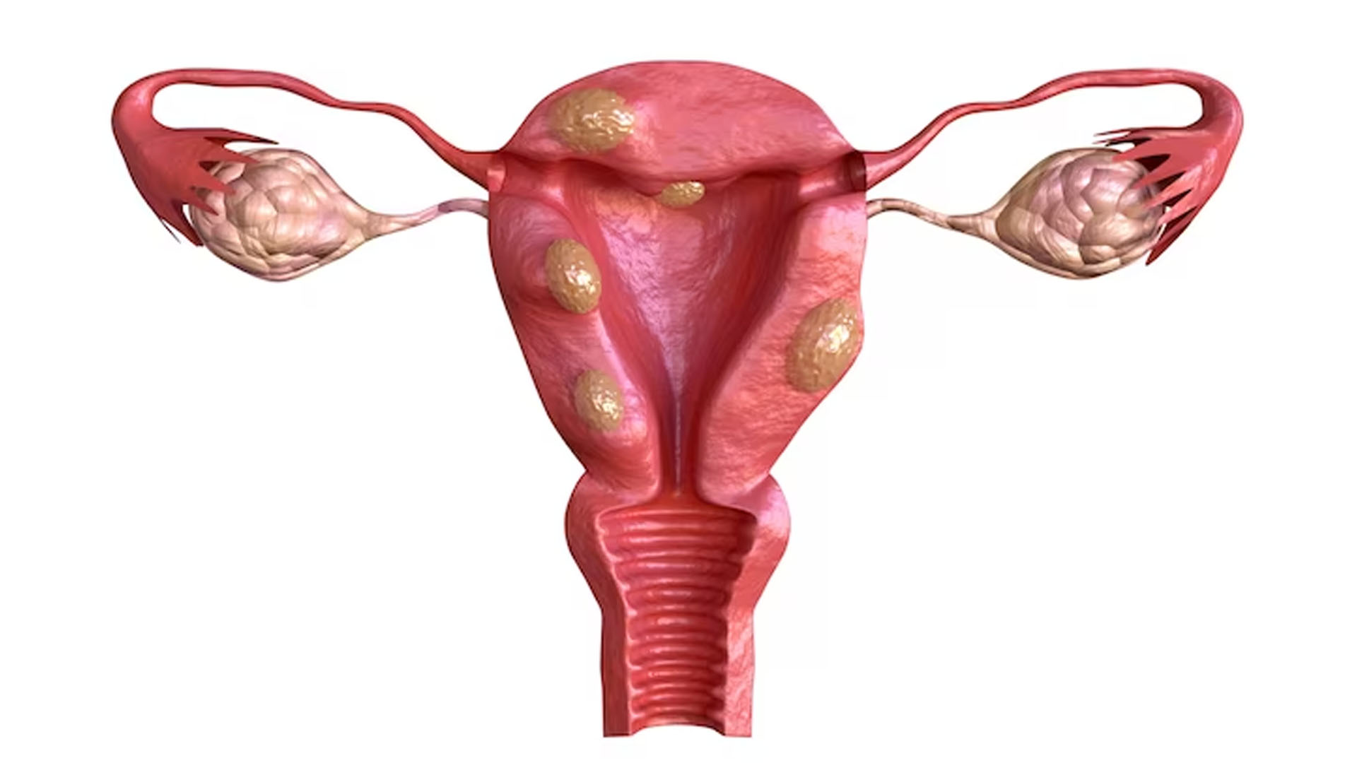 What are the Causes and Symptoms of Endometriosis?