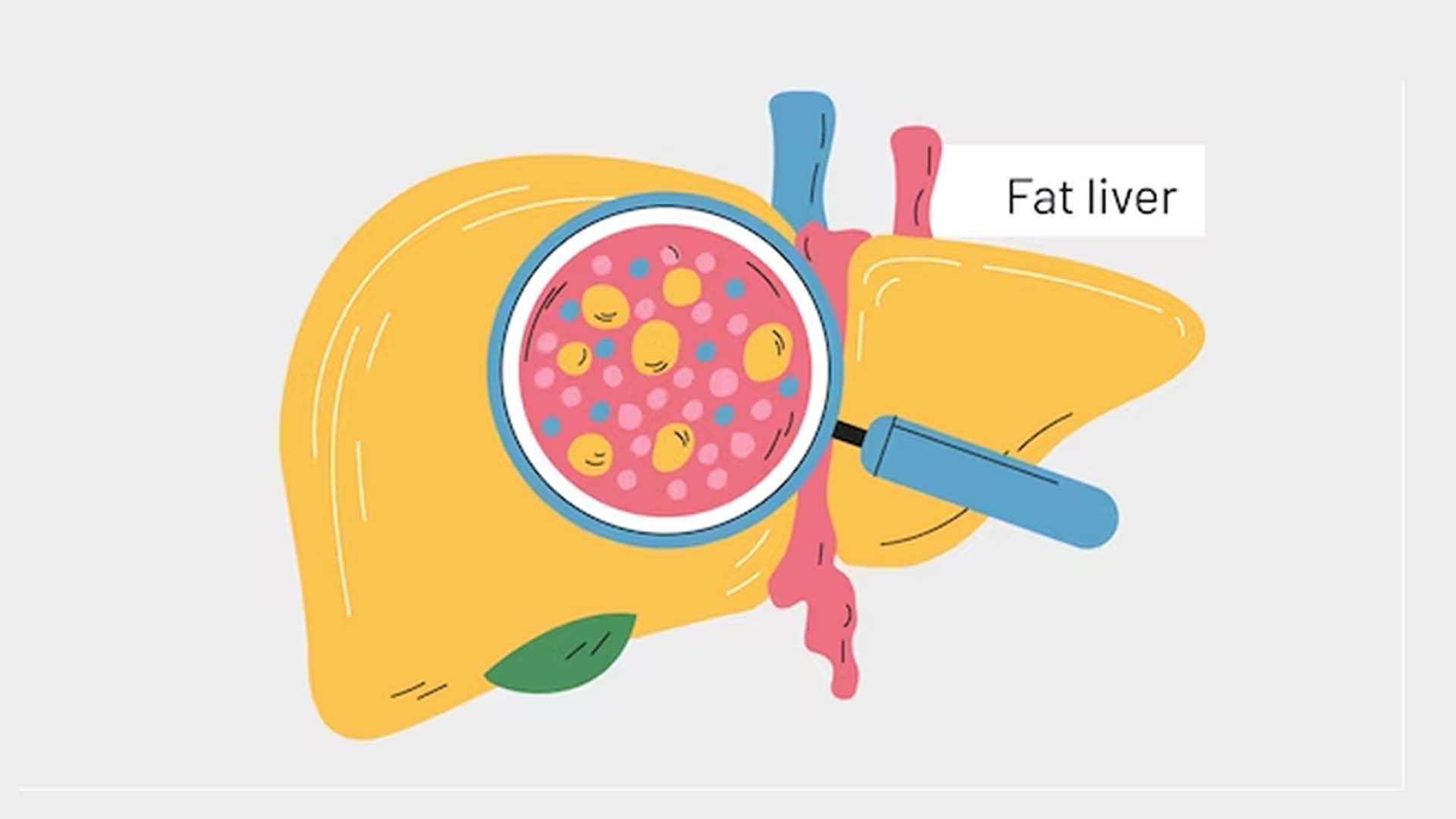 Fatty liver disease