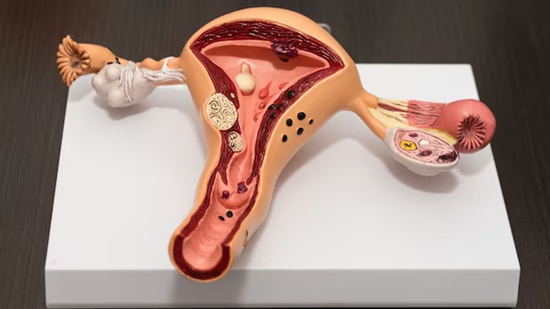 What are the Symptoms of Fibroids in Uterus?