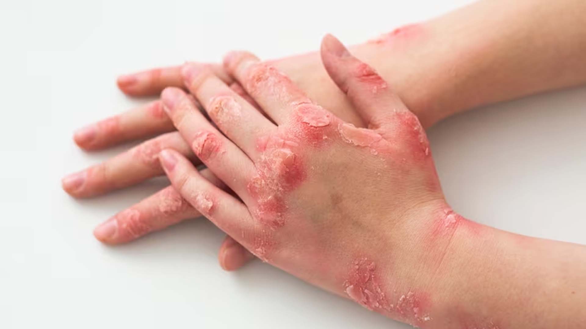 Psoriasis Patient Hand