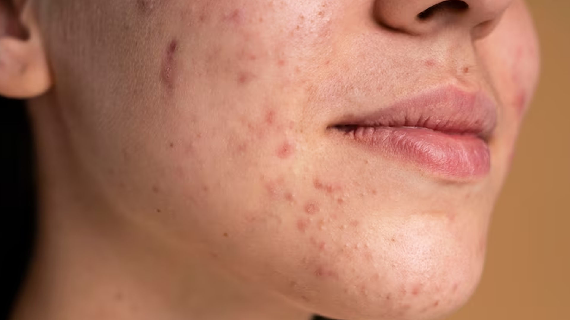 Is Herpes a Symptom of HIV?
