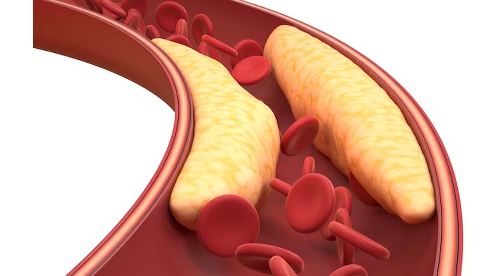 High Cholesterol