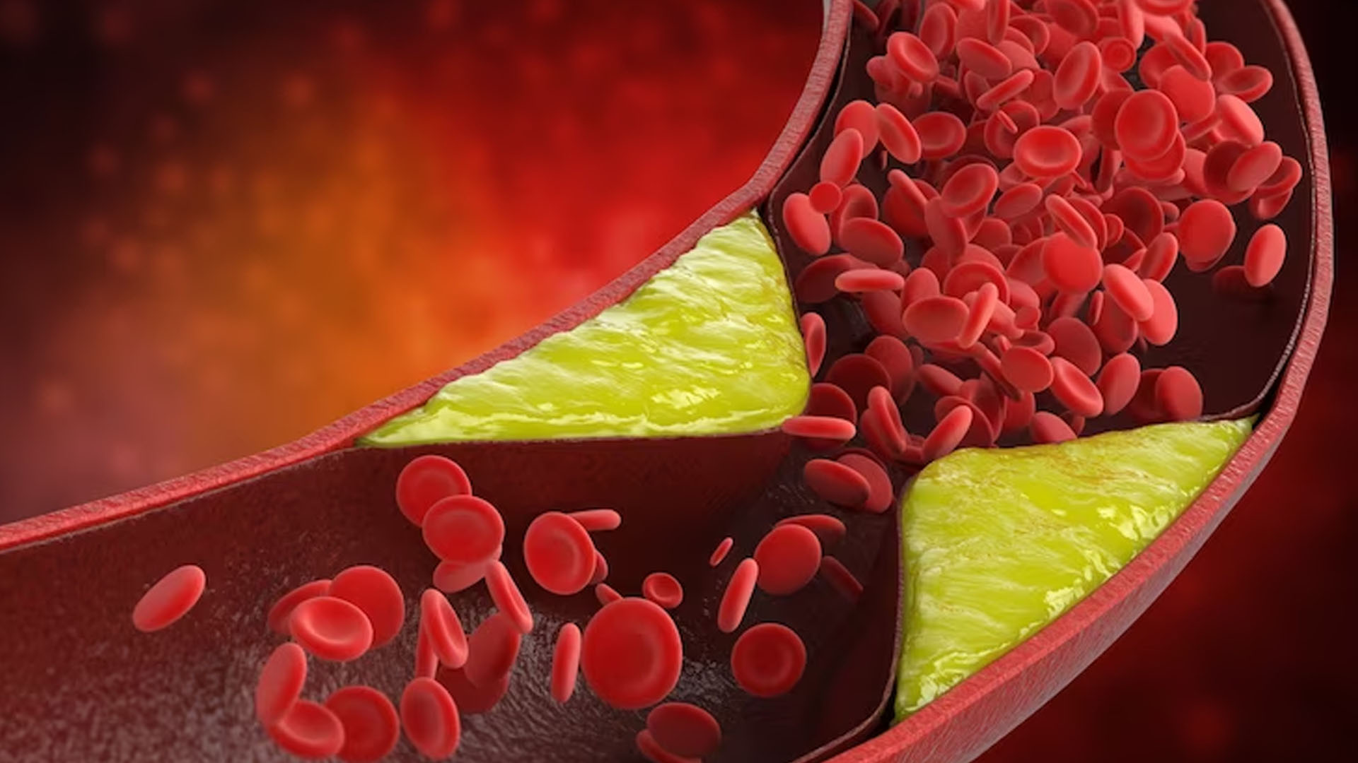 What are the Symptoms of High Cholesterol in the Body?