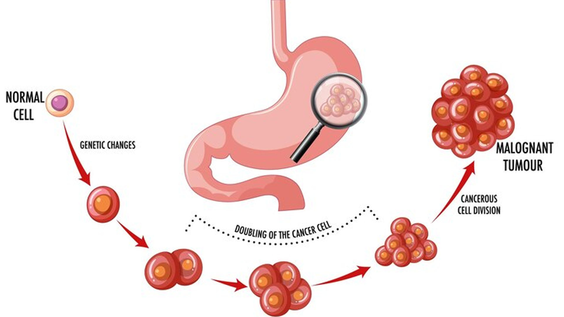 What are the Symptoms of Intestinal Cancer?