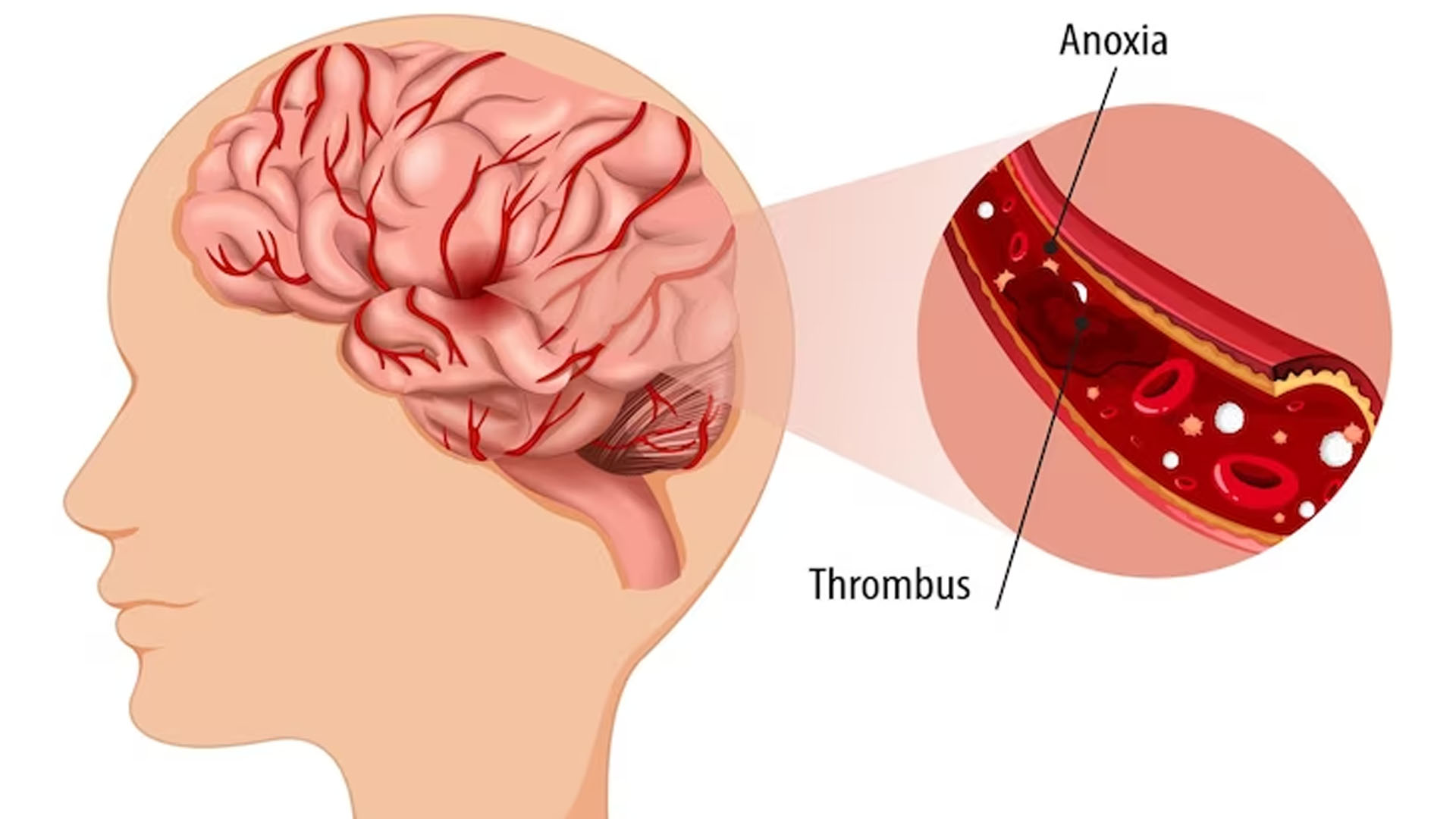 What are the Symptoms of Ischemia of the Brain?