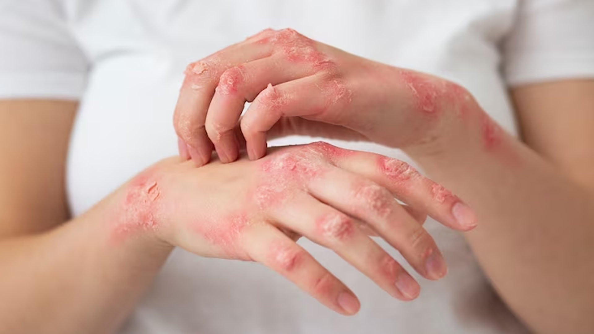 What are the Symptoms of Leprosy?