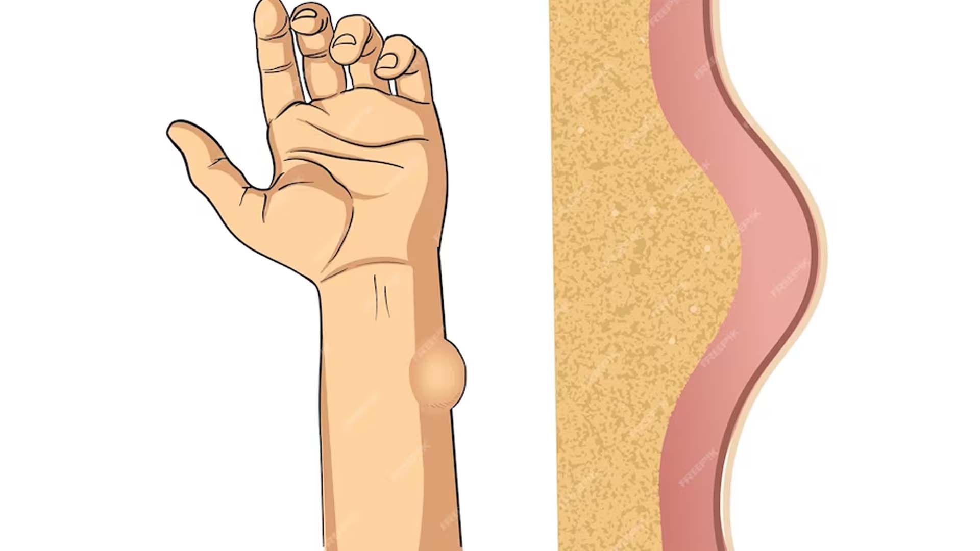 Lipomas in hand