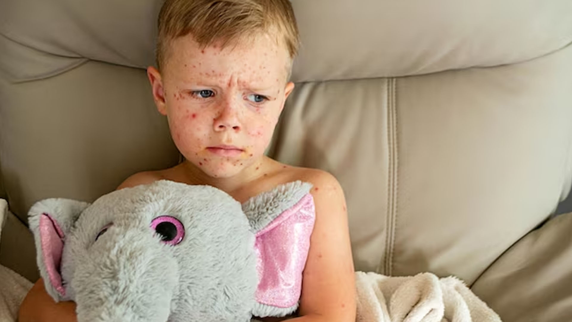 What are the Symptoms of Measles?
