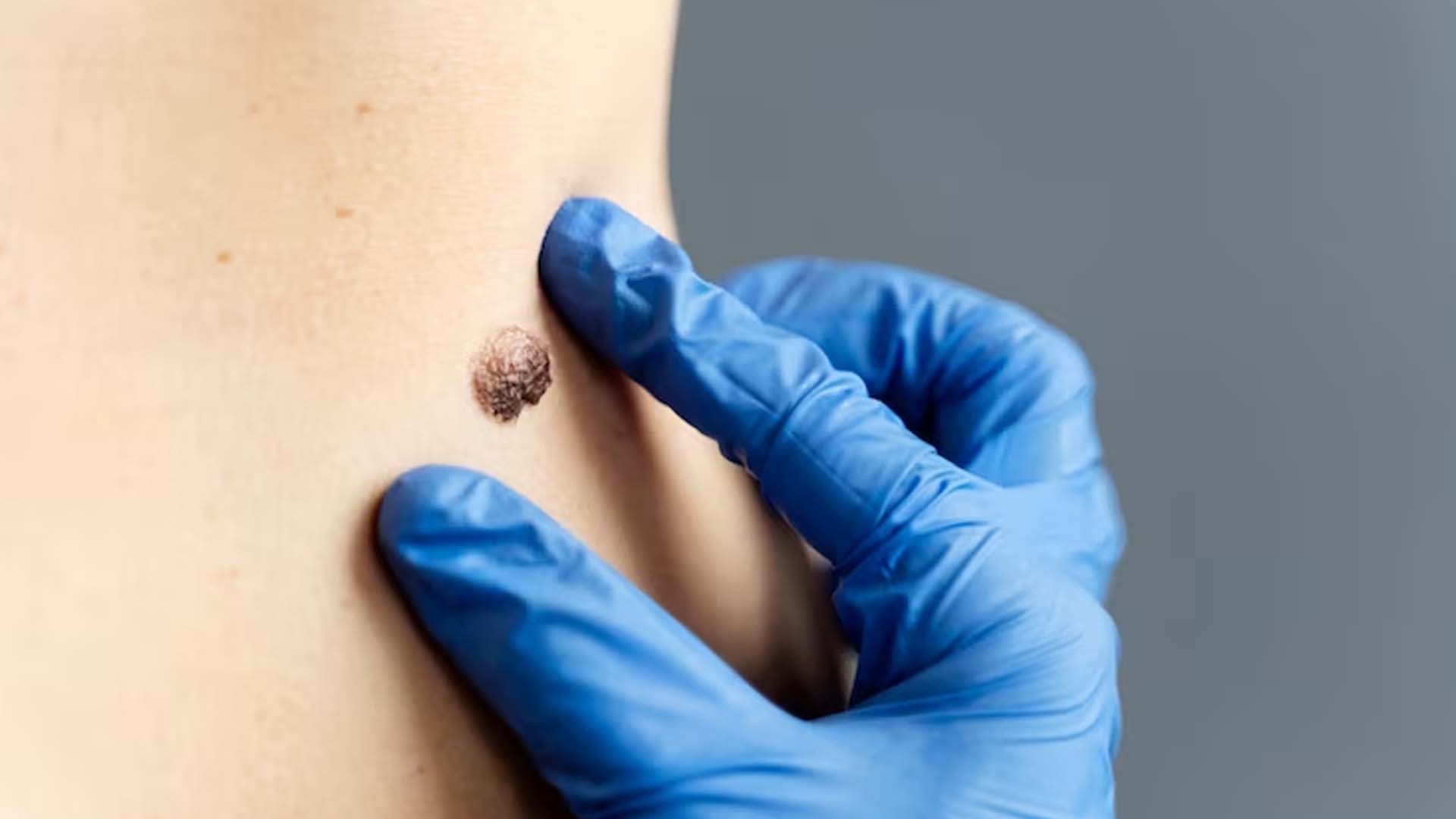 Mole Removing
