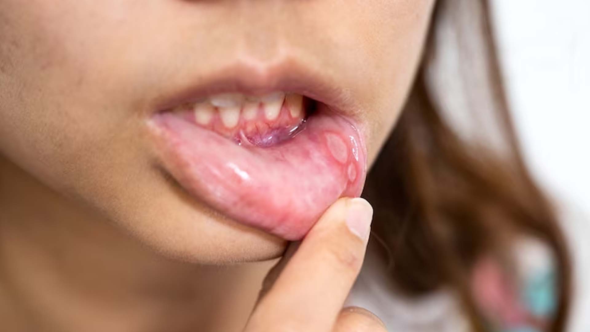 Canker sores or Mouth Ulcers