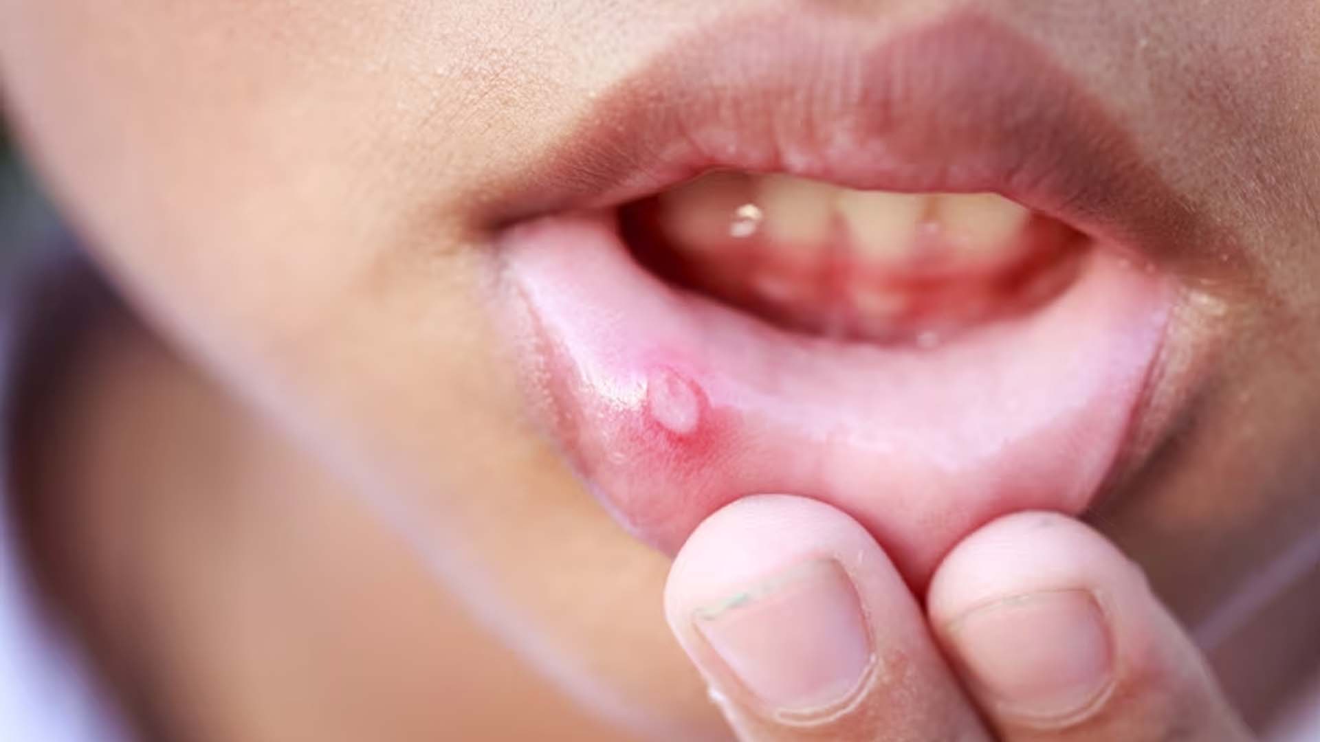 Mouth Ulcers