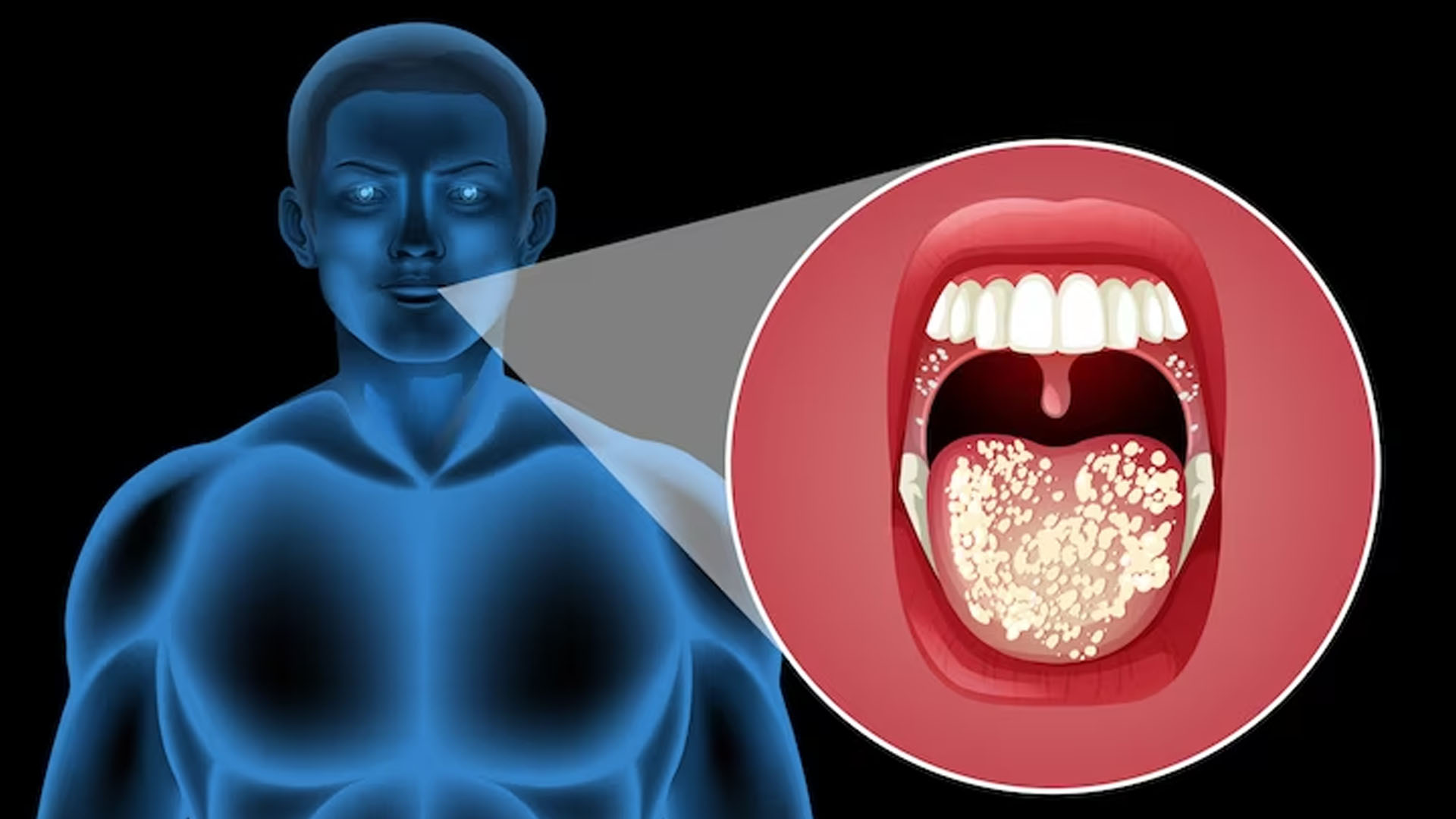 What are the Symptoms of Oral Cancer?