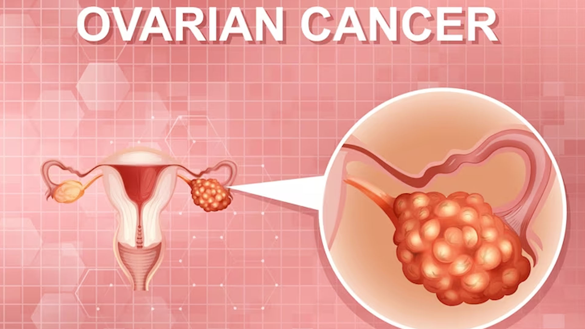 What are the Symptoms of Ovarian Cancer?