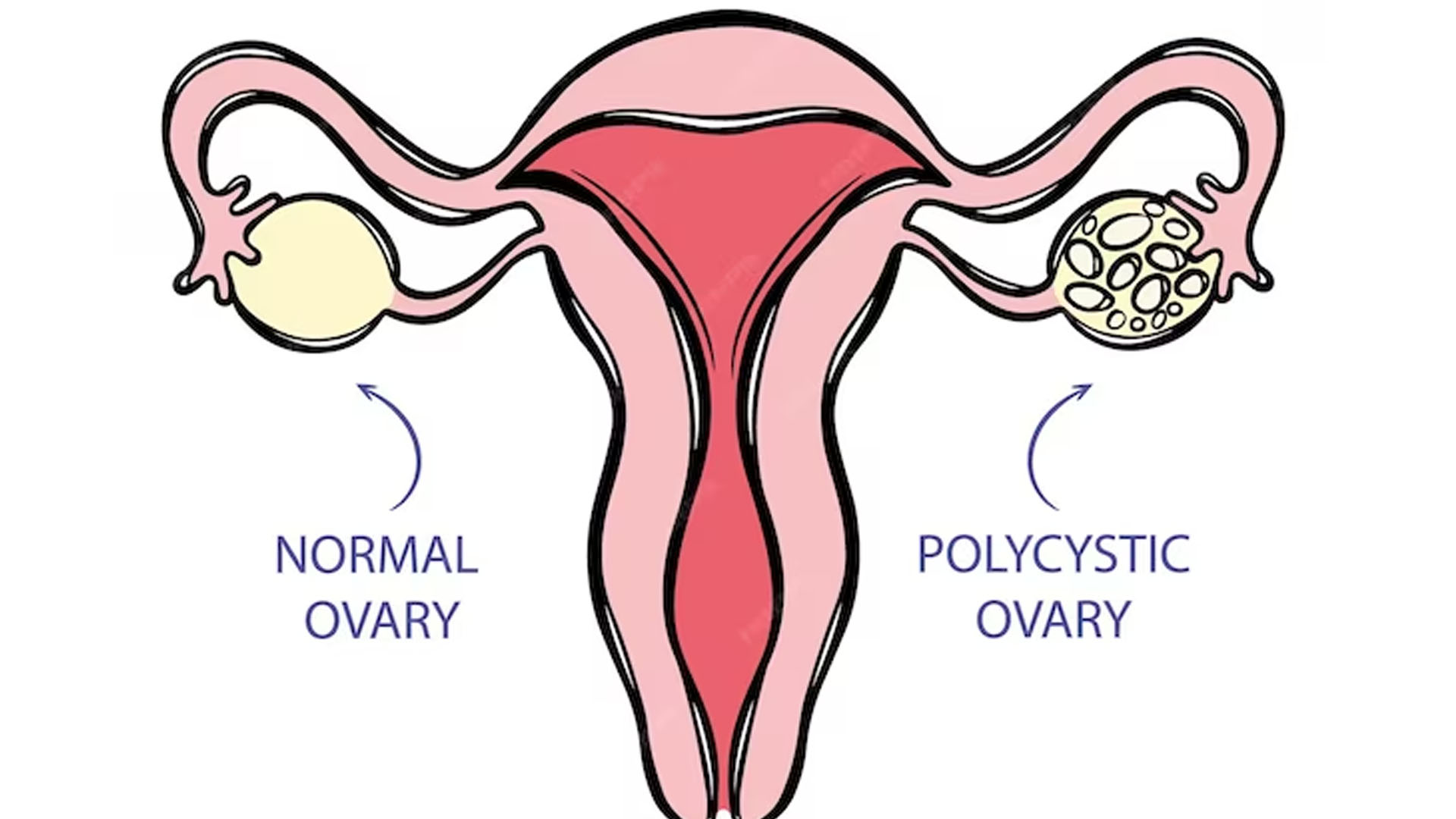 What are the Symptoms of Ovarian Tumor?