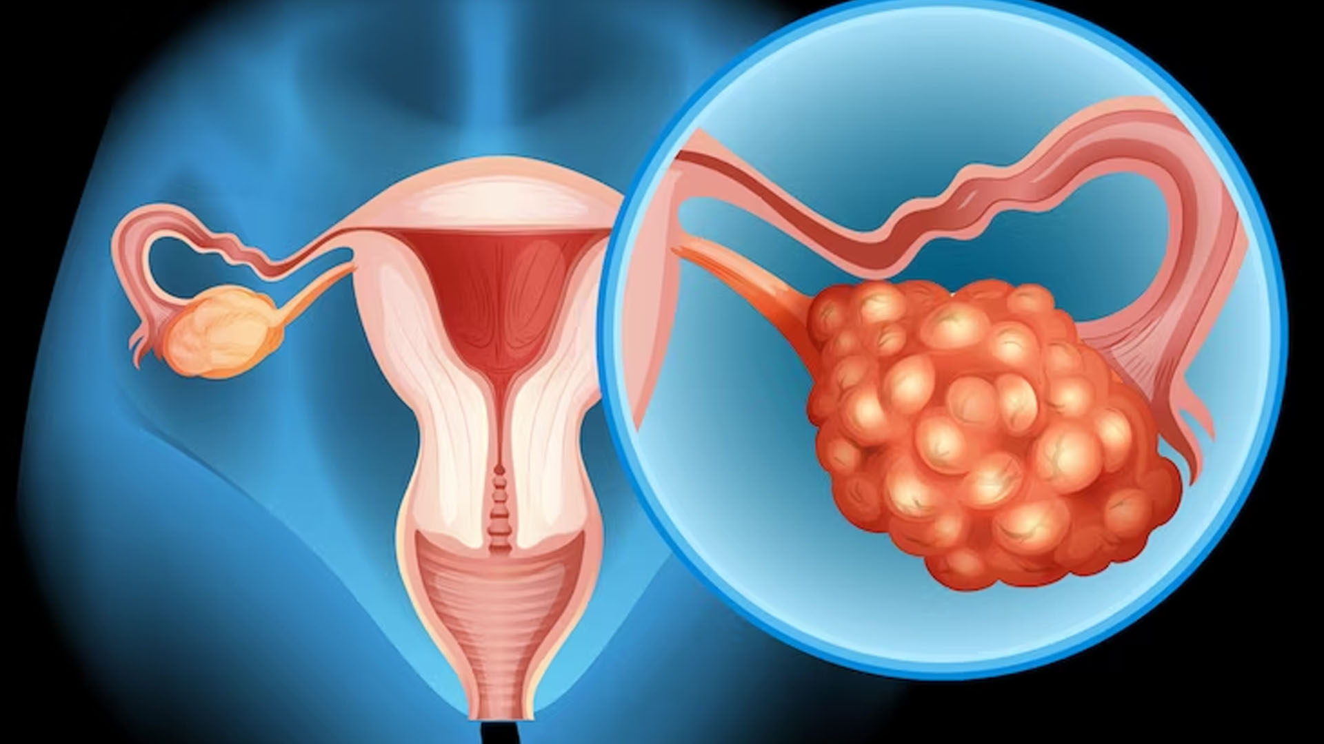 What are the Symptoms of Polycystic Ovarian Disease?
