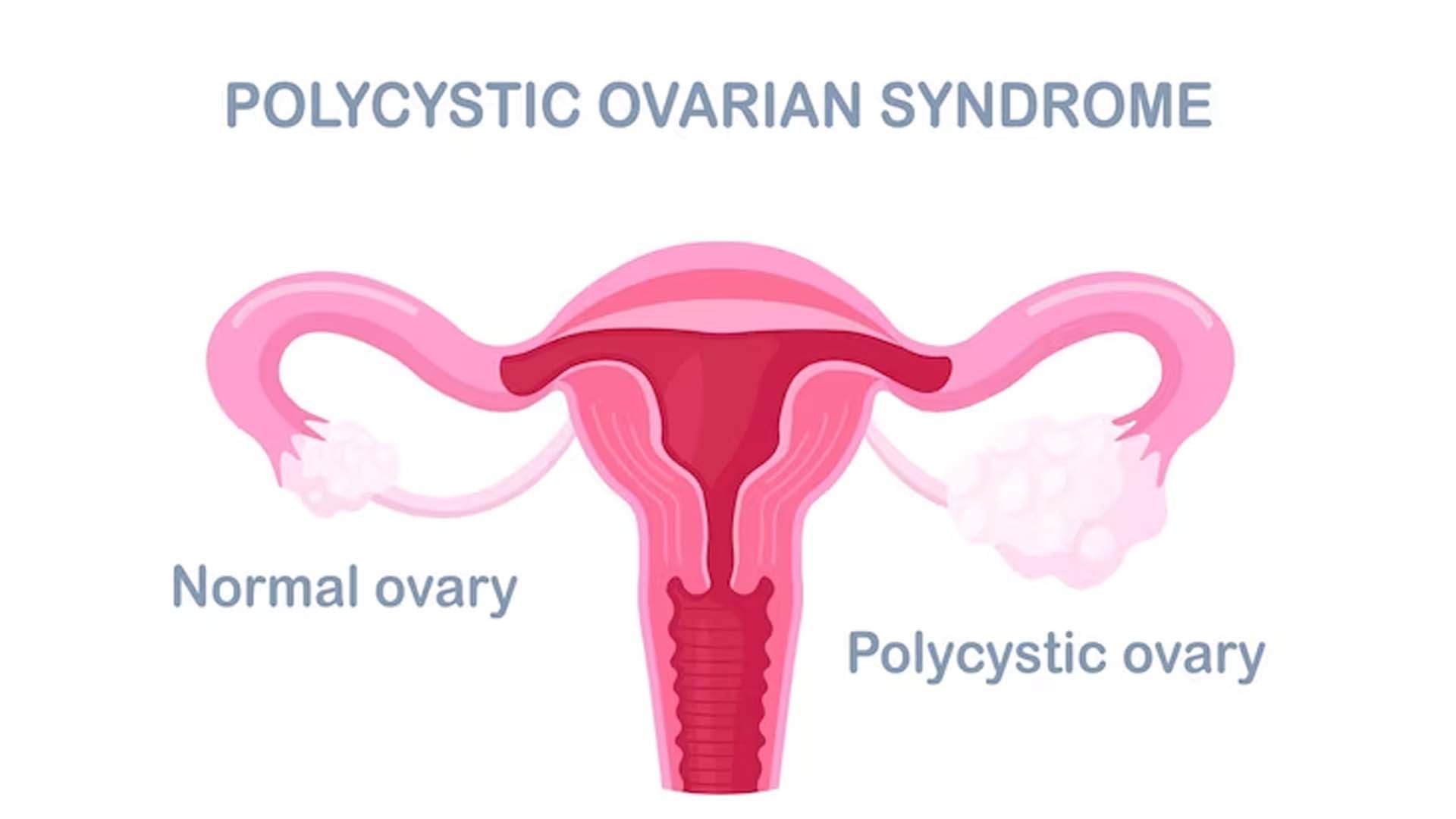 Polycystic ovary syndrome (PCOS)