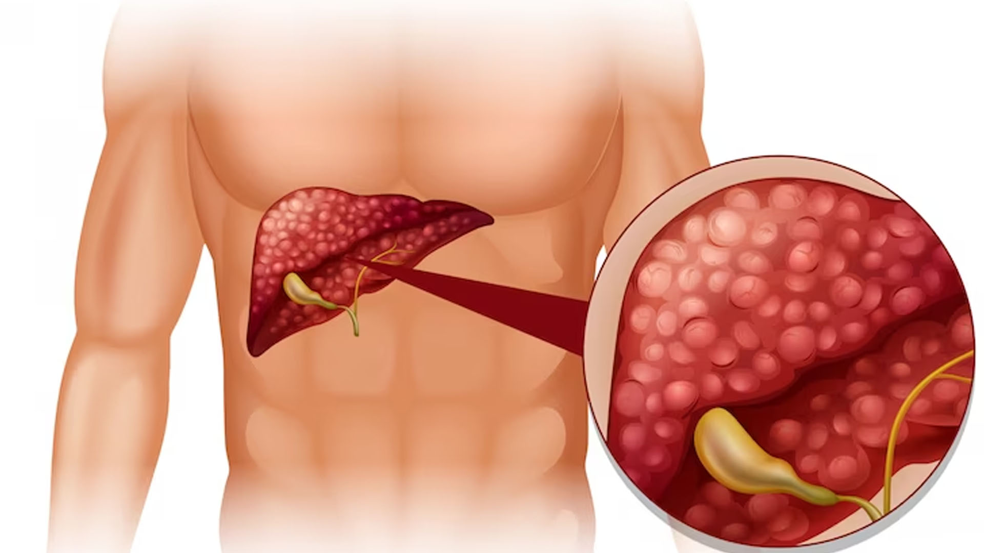 What are the Symptoms of Pancreatic Cancer in Woman?