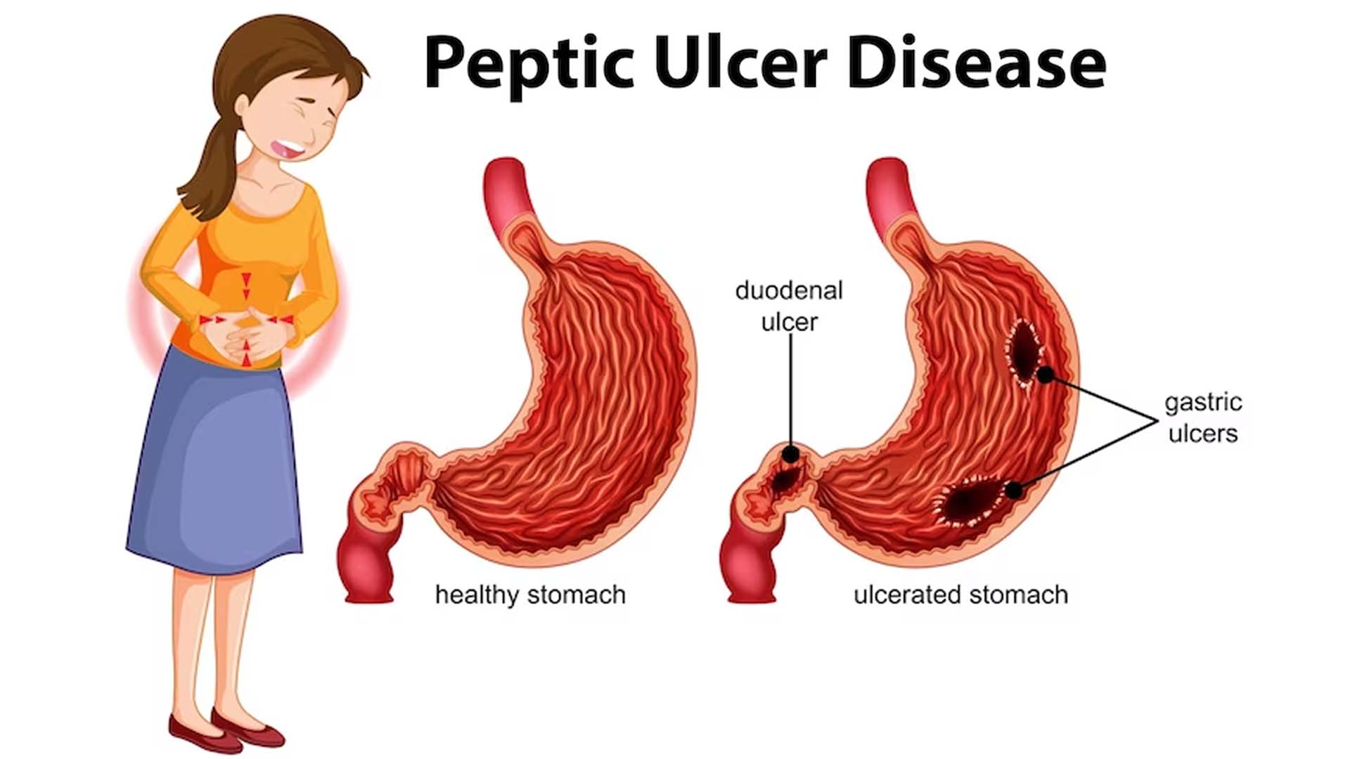 Peptic Ulcer