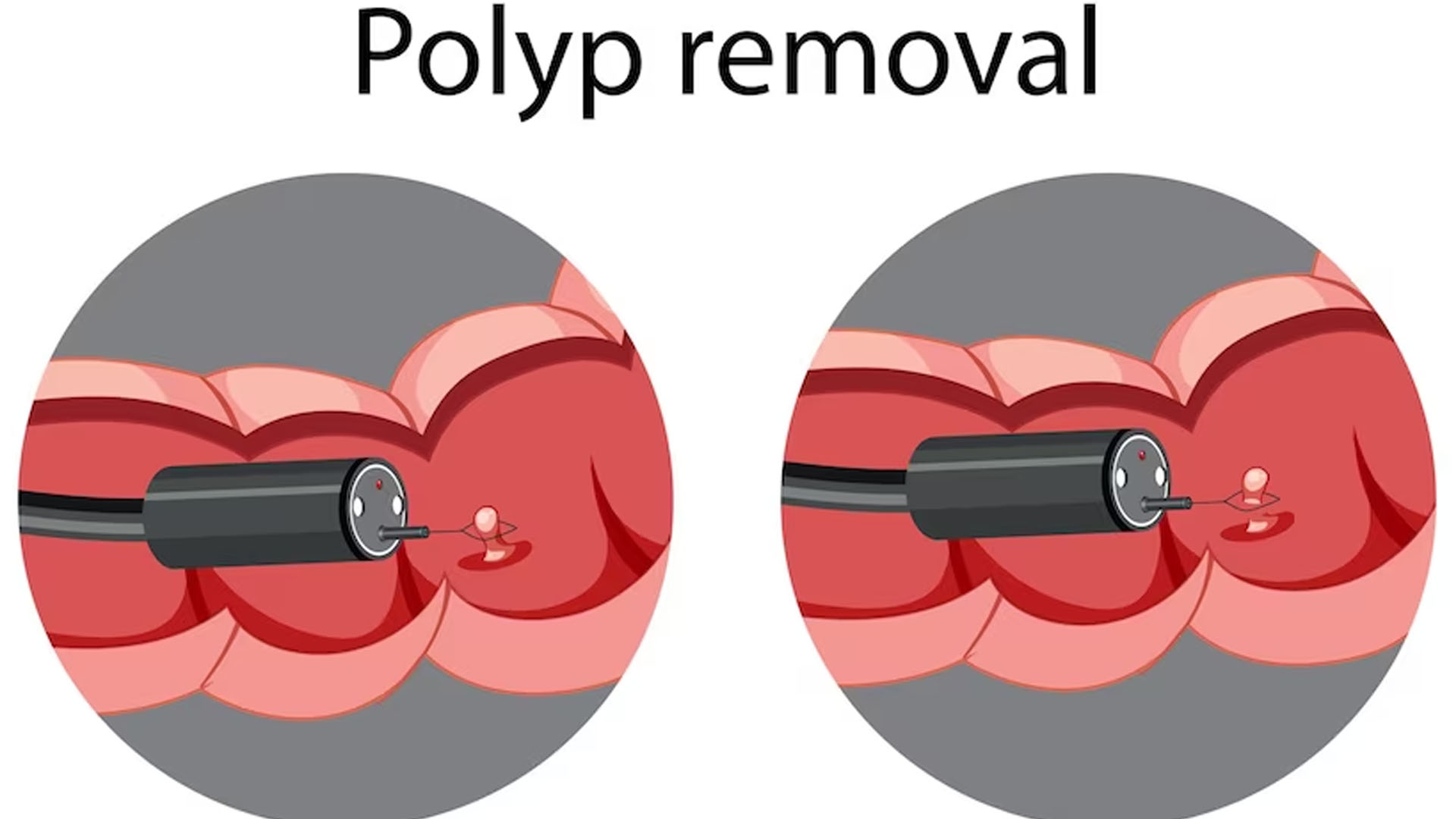 Can Benign Polyps Cause Symptoms?