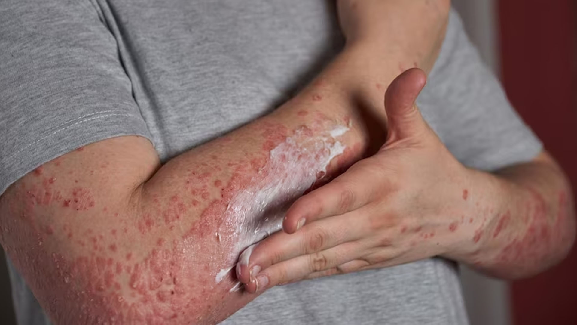 What Are The Symptoms of Psoriasis?