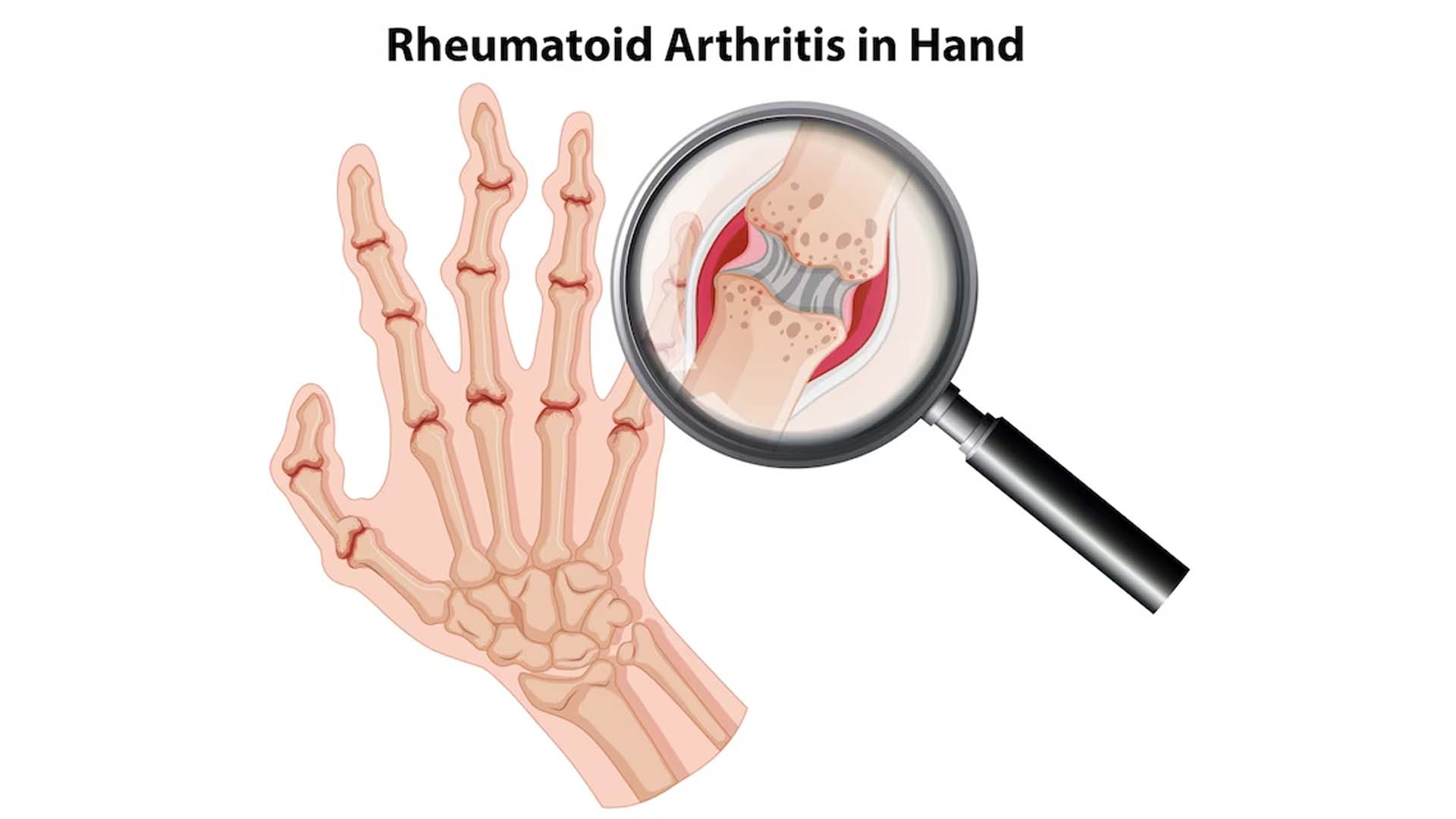 Rheumatoid Arthritis in hand