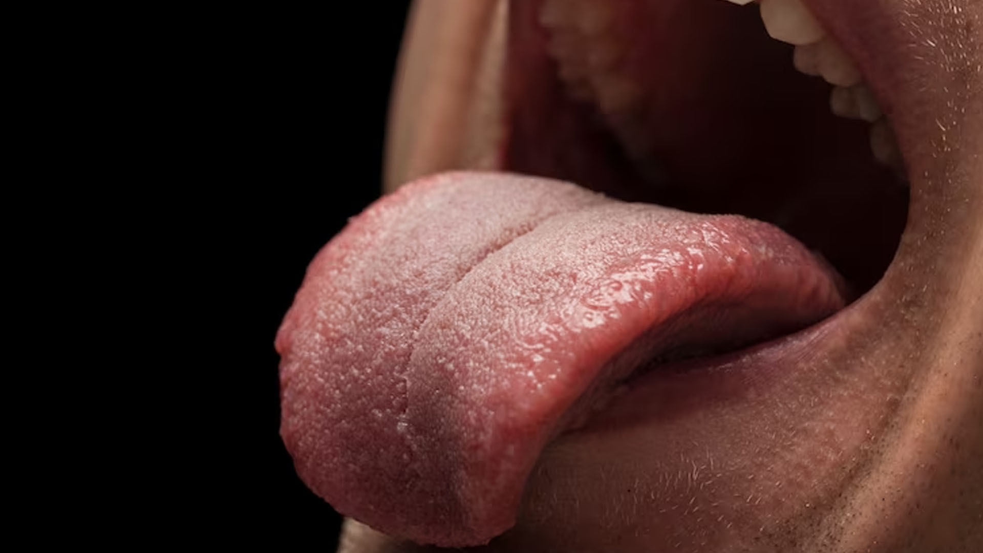 What are the Symptoms of Tongue Cancer?