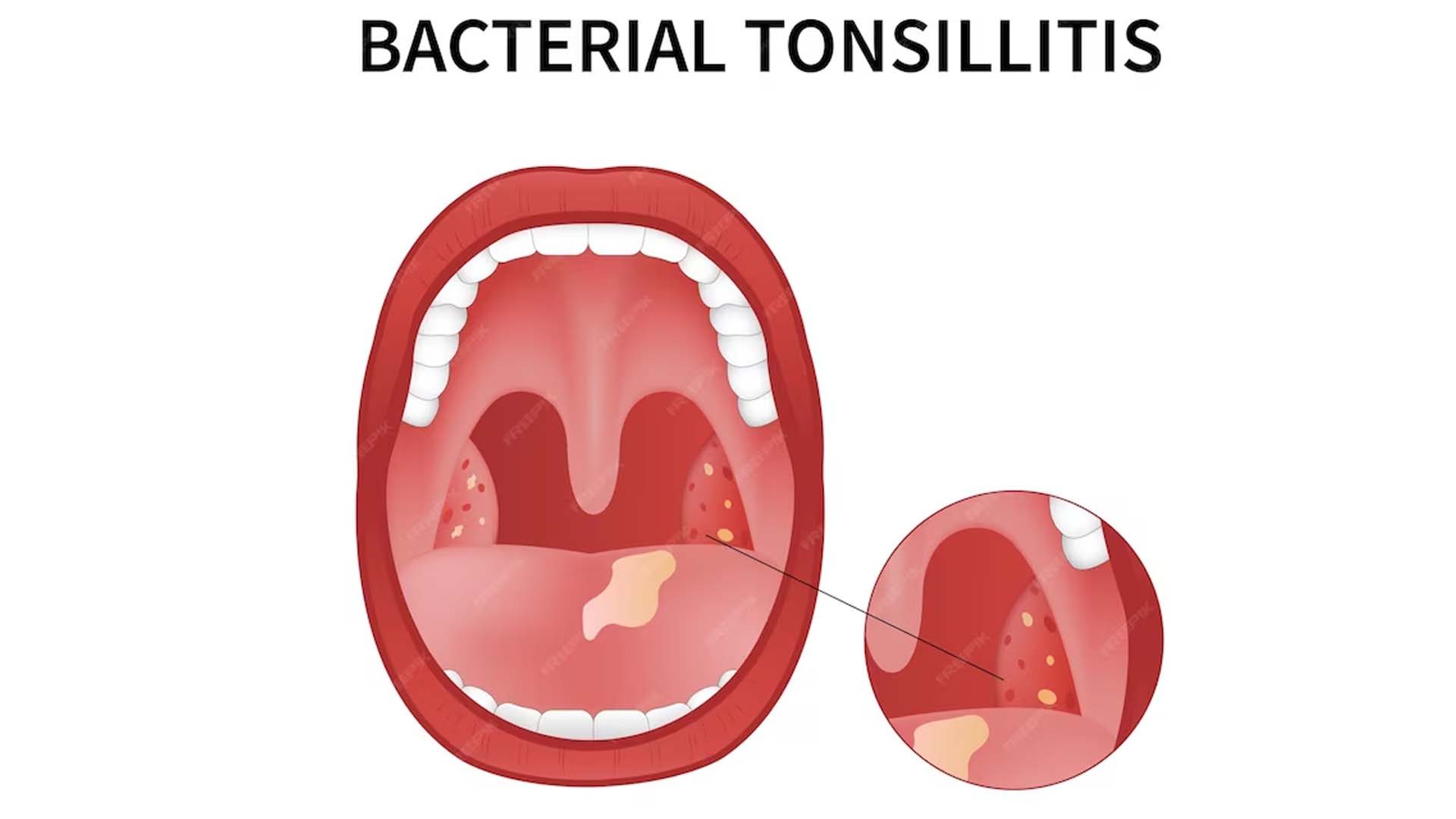 Bacterial Tonsillitis