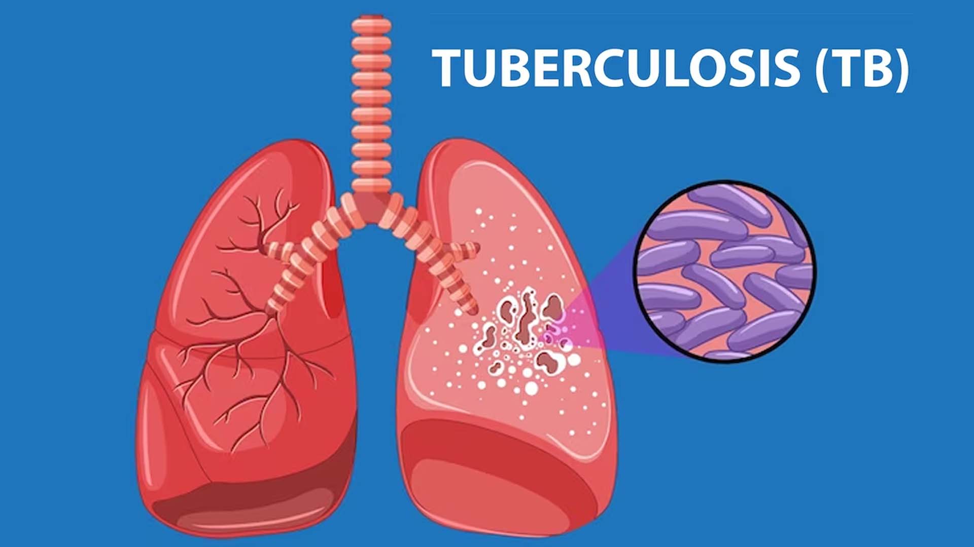 Tuberculosis caused with bacteria