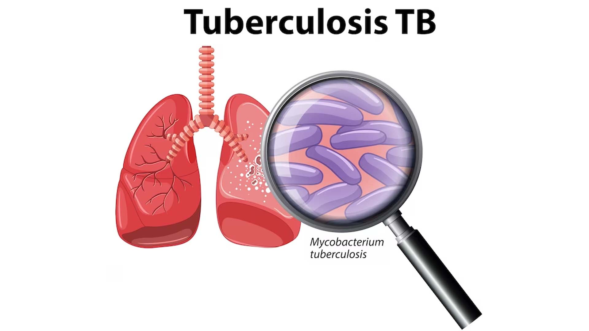TB Disease