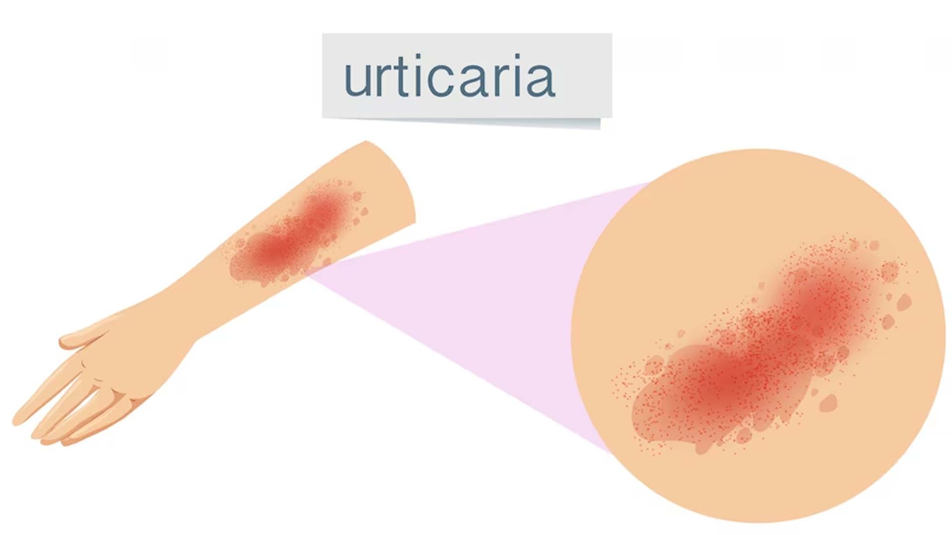 Urticaria or skin infection