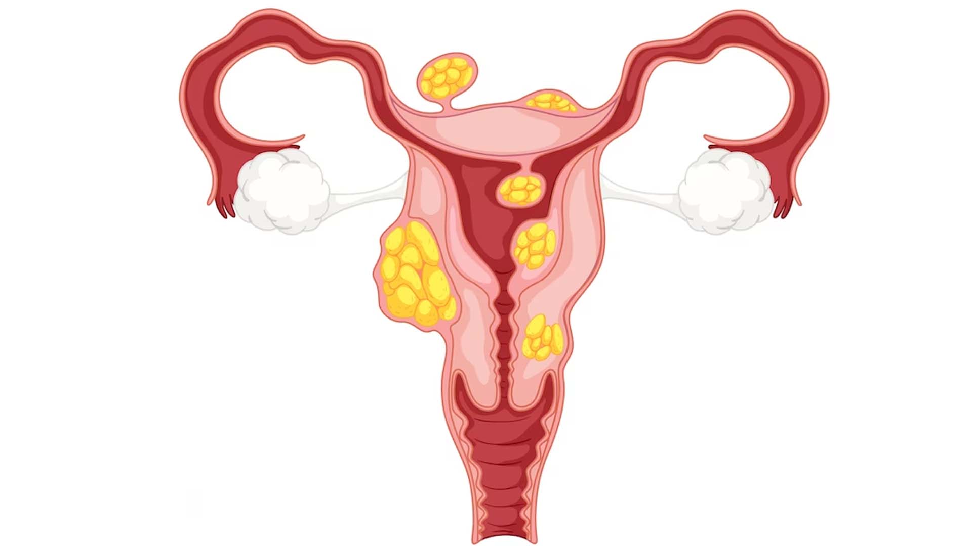 Fibroids