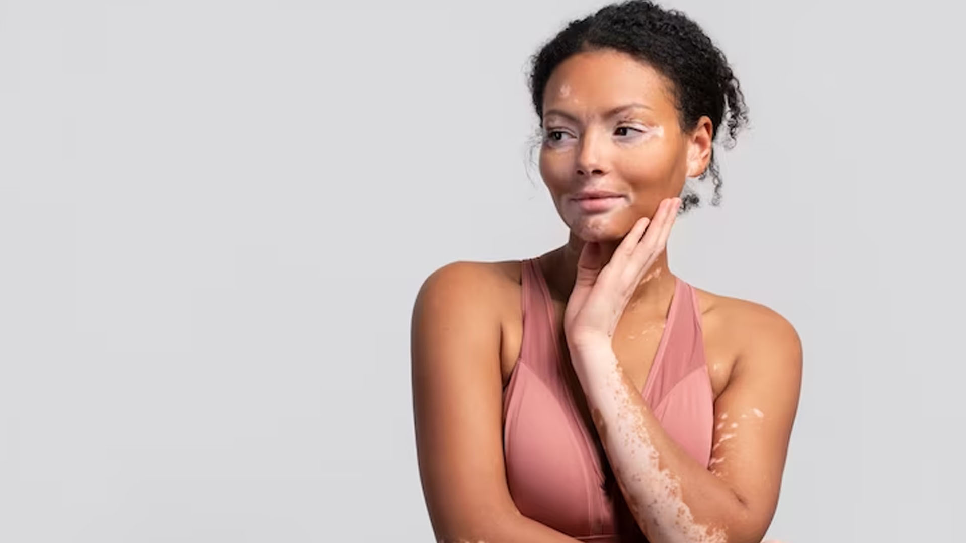 What are the Symptoms of Vitiligo?