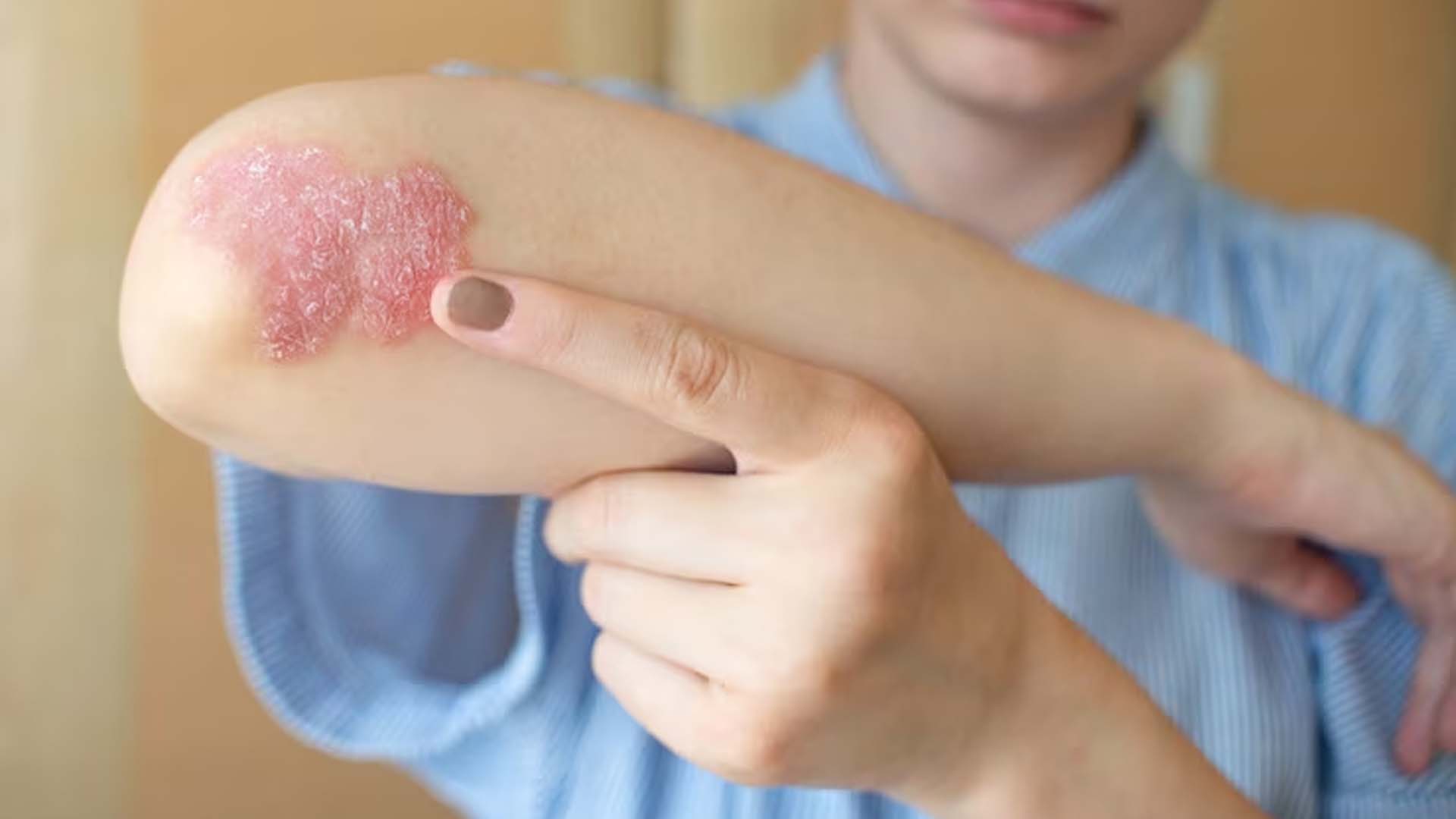 Fungal Infection (psoriasis)