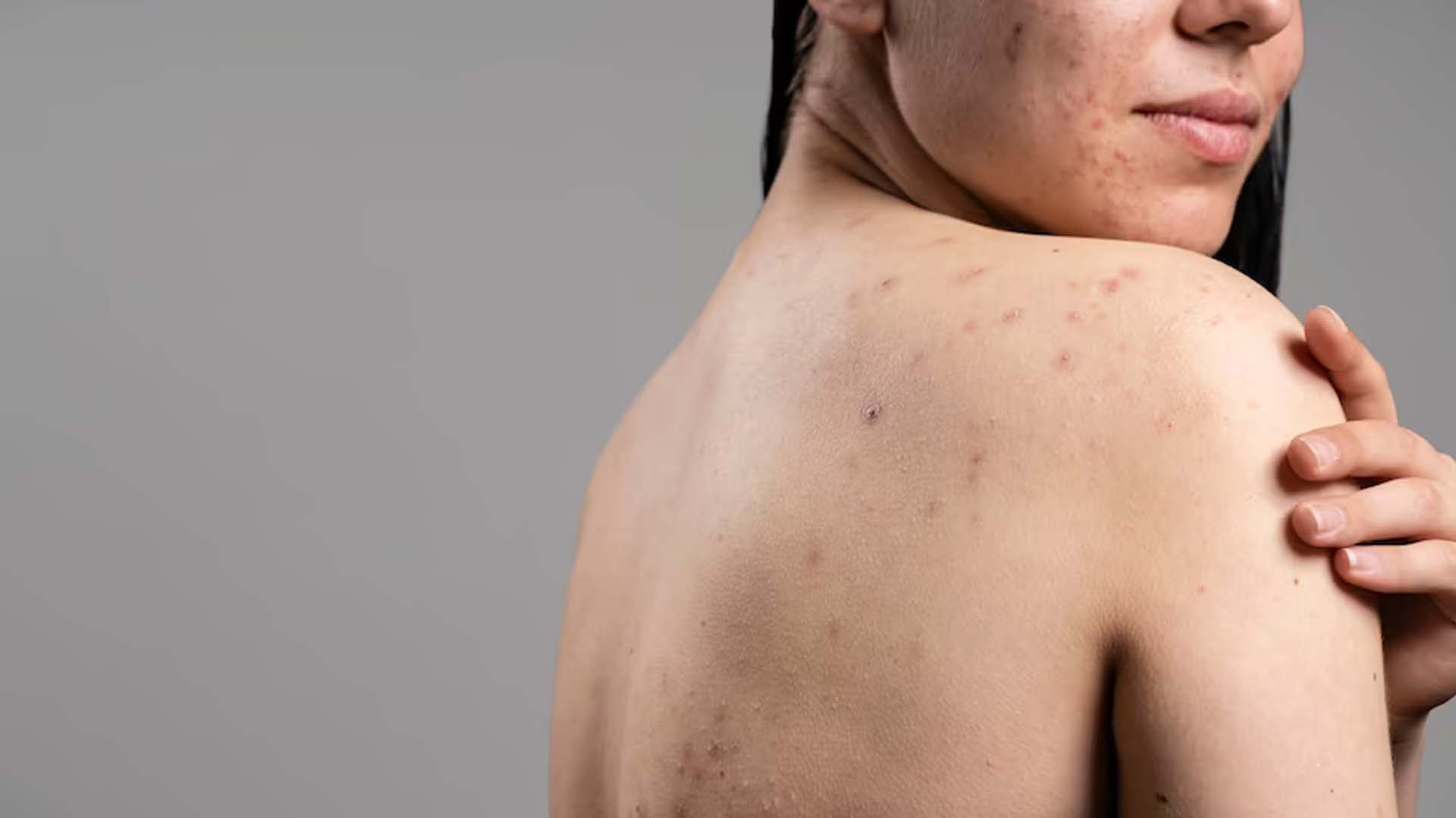 Back acne or Chest acne