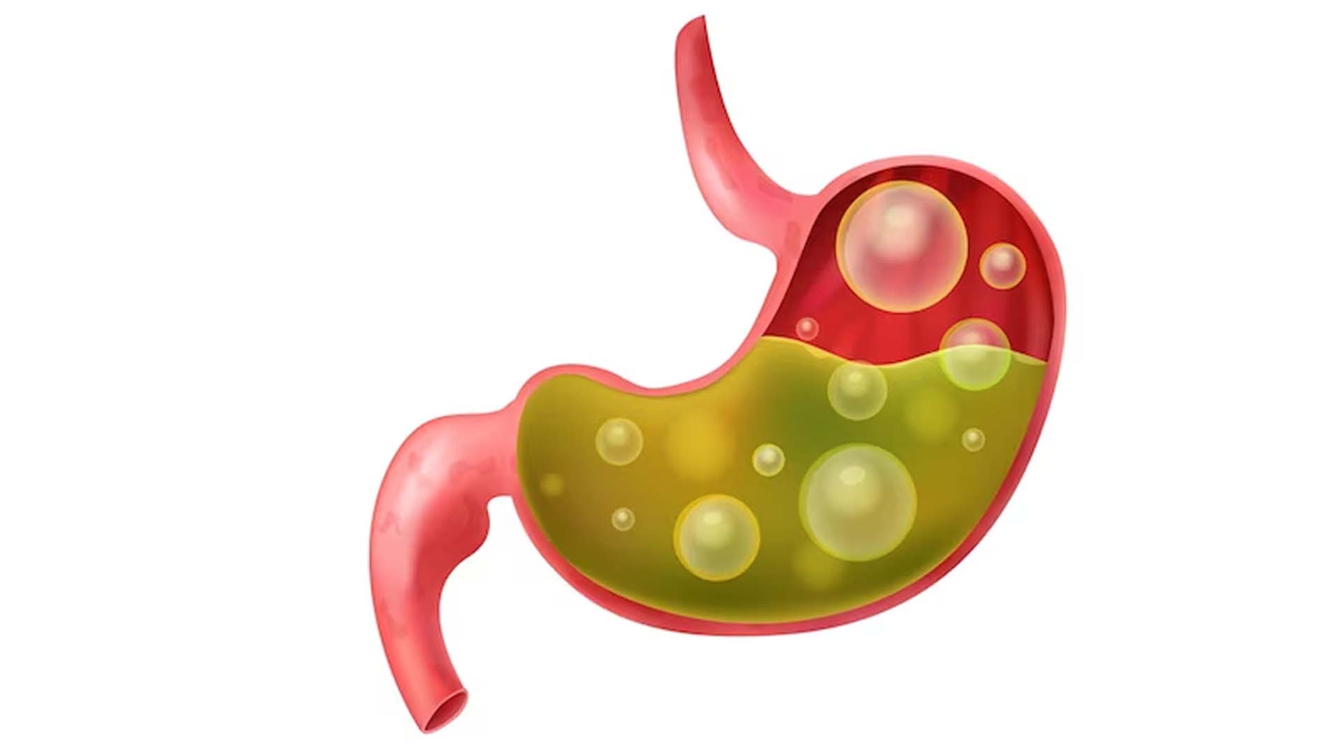 Acidity or acid reflux