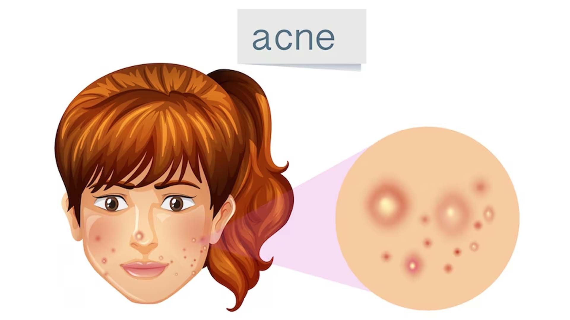 Acne in Women Illustration