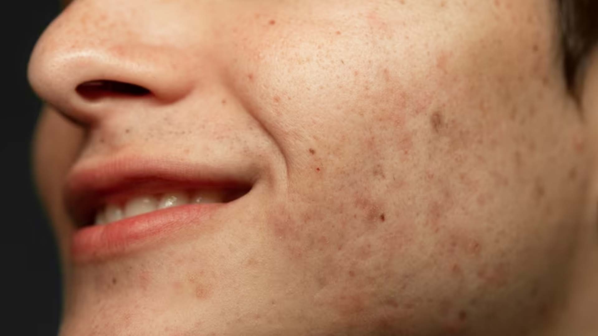 Acne scars