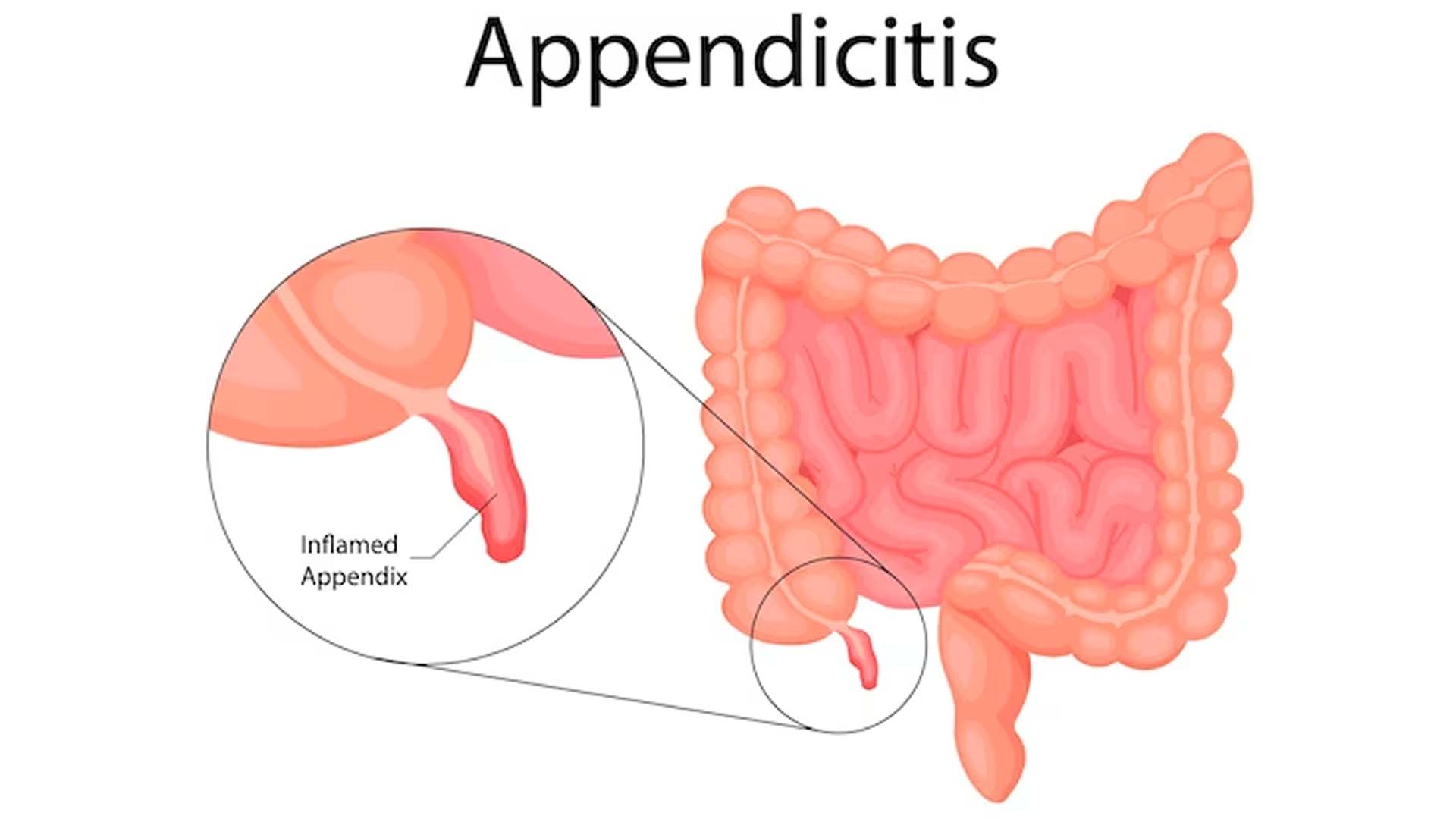 Appendicitis Illustration