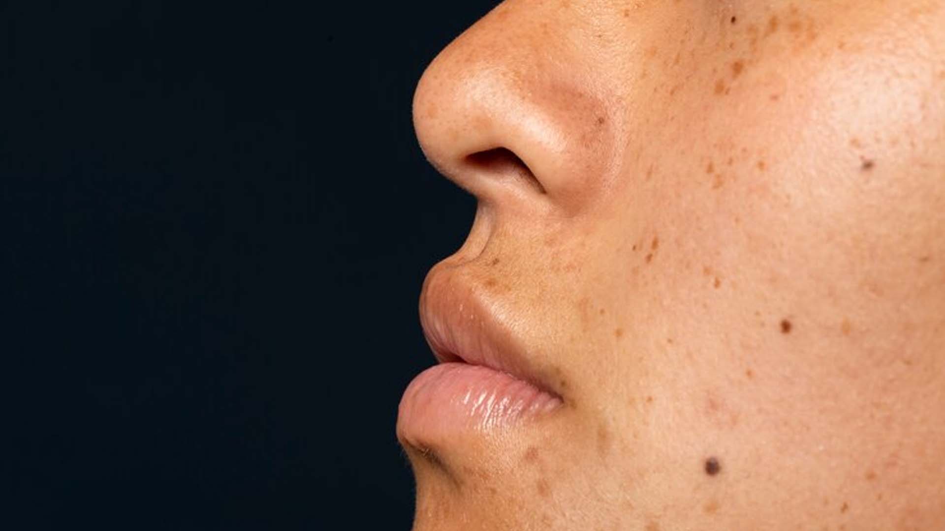 Dark spots or hyperpigmentation