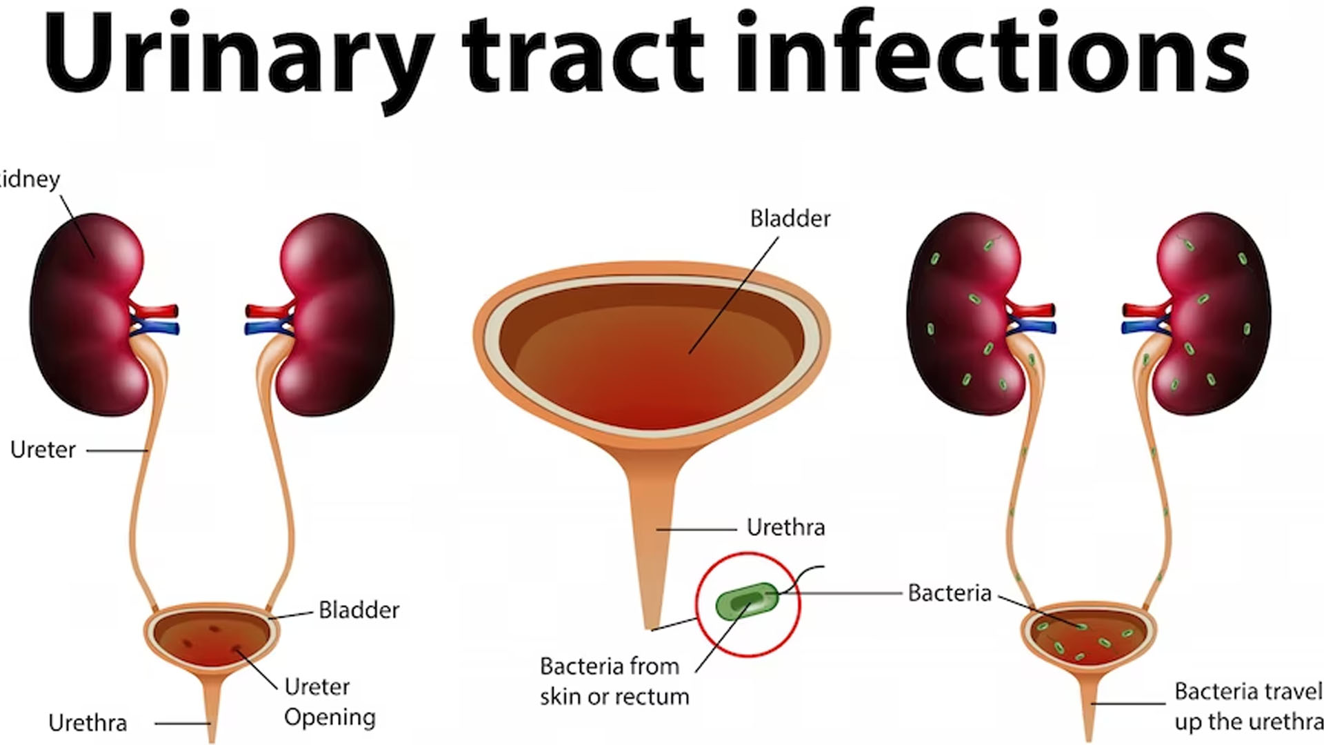 What are the Symptoms of a Prolapsed Bladder?