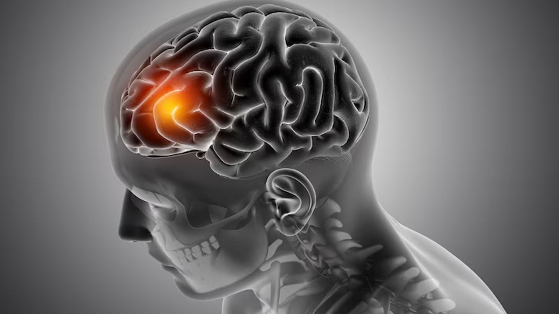 What are the Symptoms of Brain Hemorrhage?